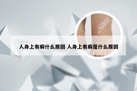 人身上有癣什么原因 人身上有癣是什么原因