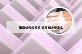 银屑病和脱发吗 银屑病会脱发么