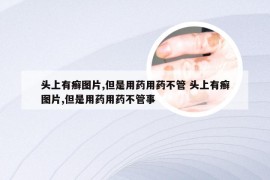 头上有癣图片,但是用药用药不管 头上有癣图片,但是用药用药不管事