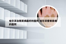 哈尔滨治银屑病最好的医院 哈尔滨看银屑病的医院