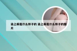 染上癣是什么样子的 染上癣是什么样子的图片