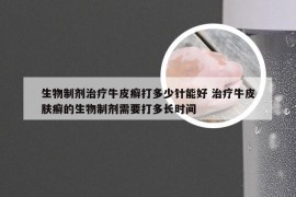 生物制剂治疗牛皮癣打多少针能好 治疗牛皮肤癣的生物制剂需要打多长时间