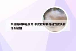 牛皮癣和神经皮炎 牛皮肤癣和神经性皮炎有什么区别