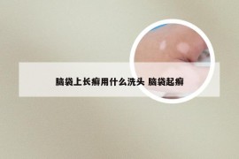 脑袋上长癣用什么洗头 脑袋起癣