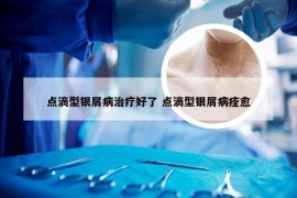 点滴型银屑病治疗好了 点滴型银屑病痊愈