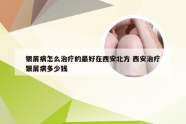 银屑病怎么治疗的最好在西安北方 西安治疗银屑病多少钱