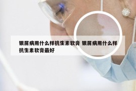 银屑病用什么样抗生素软膏 银屑病用什么样抗生素软膏最好