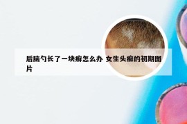 后脑勺长了一块癣怎么办 女生头癣的初期图片