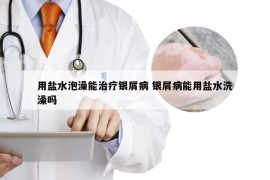 用盐水泡澡能治疗银屑病 银屑病能用盐水洗澡吗