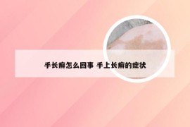 手长癣怎么回事 手上长癣的症状