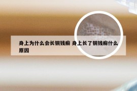 身上为什么会长铜钱癣 身上长了铜钱癣什么原因