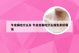 牛皮癣吃什么补 牛皮皮癣吃什么维生素好得快