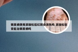 银屑病使用派瑞松后红斑会消失吗 派瑞松软膏能治银屑病吗