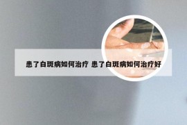 患了白斑病如何治疗 患了白斑病如何治疗好