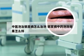 中医泡治银屑病怎么治泡 银屑病中药泡洗效果怎么样