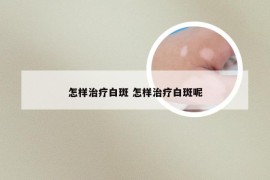 怎样治疗白斑 怎样治疗白斑呢