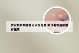 武汉银屑病哪里可以打苏金 武汉看银屑病推荐医生