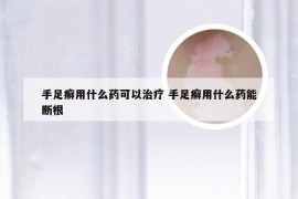 手足癣用什么药可以治疗 手足癣用什么药能断根