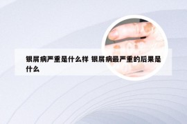 银屑病严重是什么样 银屑病最严重的后果是什么