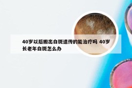 40岁以后搬出白斑遗传的能治疗吗 40岁长老年白斑怎么办