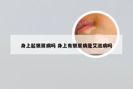 身上起银屑病吗 身上有银屑病是艾滋病吗