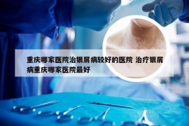 重庆哪家医院治银屑病较好的医院 治疗银屑病重庆哪家医院最好