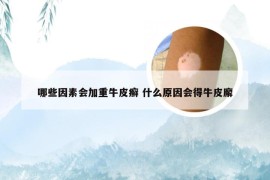 哪些因素会加重牛皮癣 什么原因会得牛皮廨