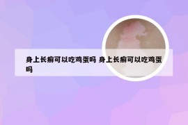 身上长癣可以吃鸡蛋吗 身上长癣可以吃鸡蛋吗