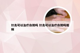 针灸可以治疗白斑吗 针灸可以治疗白斑吗视频