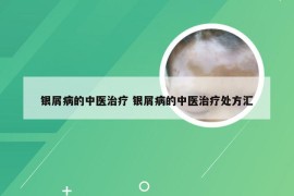 银屑病的中医治疗 银屑病的中医治疗处方汇