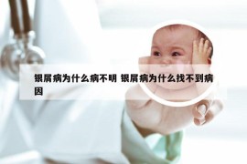 银屑病为什么病不明 银屑病为什么找不到病因