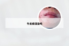 牛皮癣渲染吗