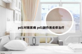 pd1对银屑病 pd1副作用皮疹治疗