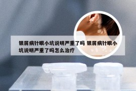 银屑病针眼小坑说明严重了吗 银屑病针眼小坑说明严重了吗怎么治疗