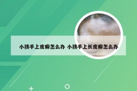 小孩手上皮癣怎么办 小孩手上长皮癣怎么办