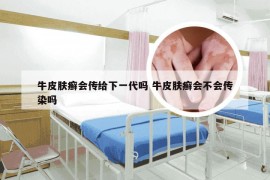 牛皮肤癣会传给下一代吗 牛皮肤癣会不会传染吗