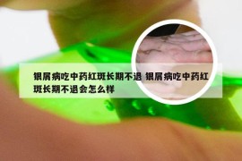 银屑病吃中药红斑长期不退 银屑病吃中药红斑长期不退会怎么样