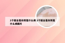 2个腿全是白斑是什么病 2个腿全是白斑是什么病图片