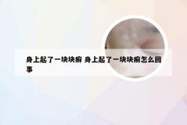 身上起了一块块癣 身上起了一块块癣怎么回事