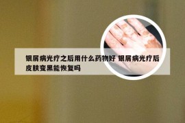 银屑病光疗之后用什么药物好 银屑病光疗后皮肤变黑能恢复吗