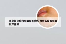 身上起皮癣和喝酒有关系吗 为什么皮癣喝酒就严重呢