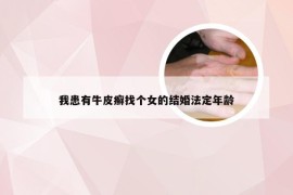 我患有牛皮癣找个女的结婚法定年龄