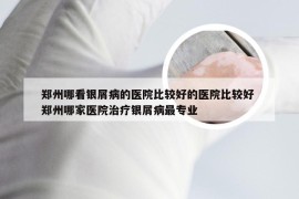 郑州哪看银屑病的医院比较好的医院比较好 郑州哪家医院治疗银屑病最专业