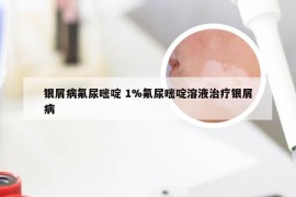 银屑病氟尿嘧啶 1%氟尿嘧啶溶液治疗银屑病