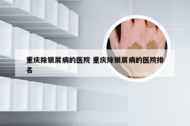 重庆除银屑病的医院 重庆除银屑病的医院排名