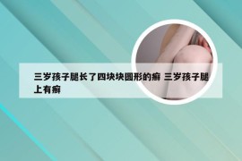 三岁孩子腿长了四块块圆形的癣 三岁孩子腿上有癣