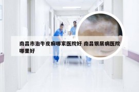 南昌市治牛皮癣哪家医院好 南昌银屑病医院哪里好