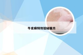 牛皮癣特效验秘偏方