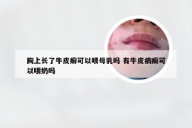 胸上长了牛皮癣可以喂母乳吗 有牛皮病癣可以喂奶吗