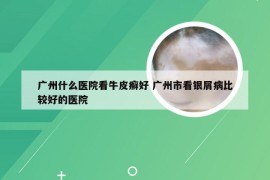 广州什么医院看牛皮癣好 广州市看银屑病比较好的医院